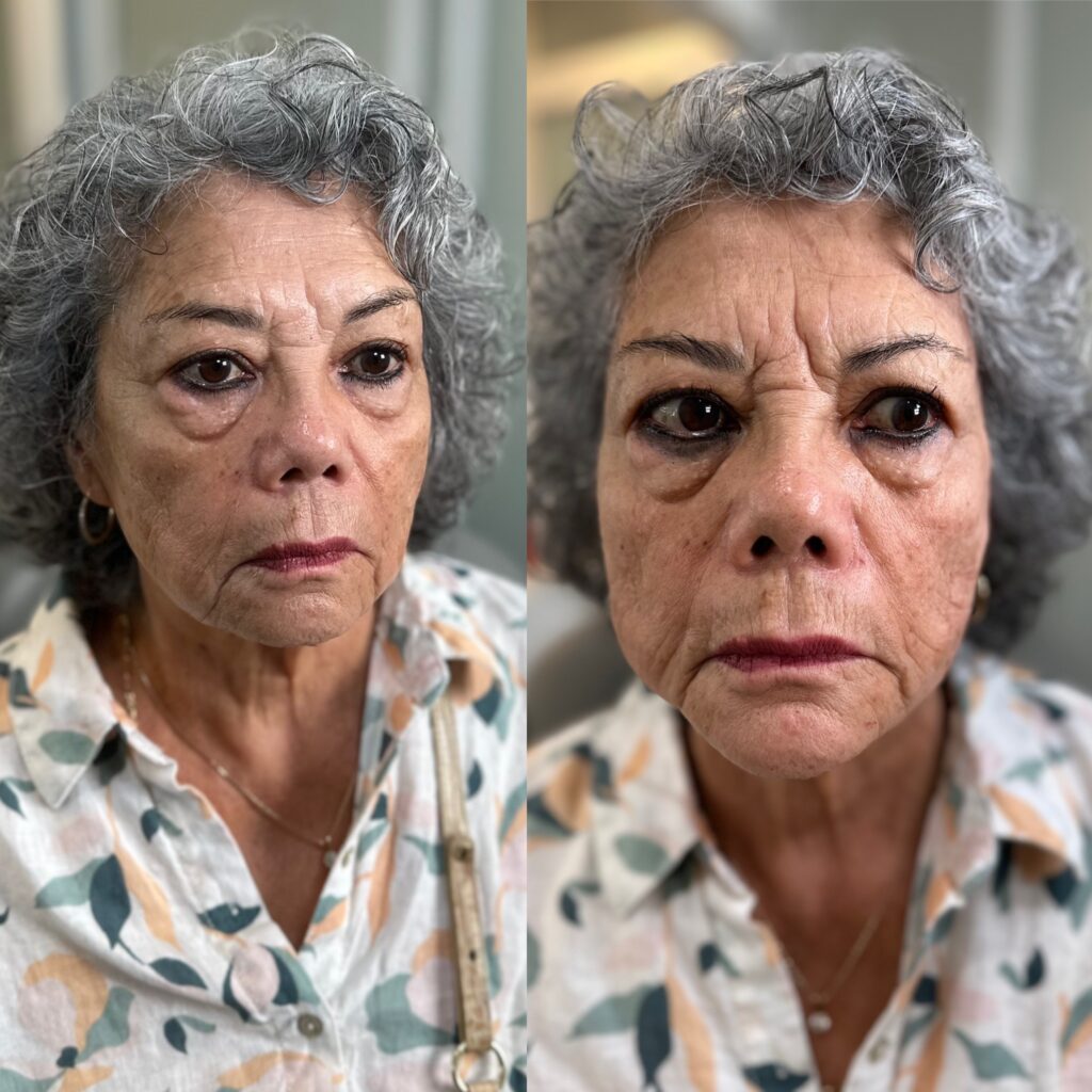 Before and after comparison of an older woman showing improvements in facial skin texture and reduced wrinkles after treatment.