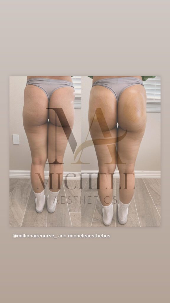 Before and after back view comparison of a woman showing improvements in buttock shape after a body sculpting treatment.