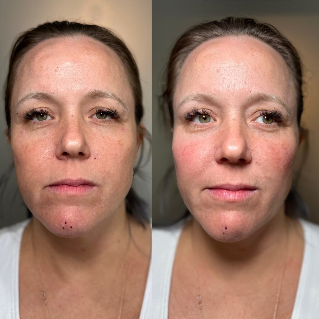 Before and after comparison of a woman’s face showing improvements in skin redness and texture after treatment.