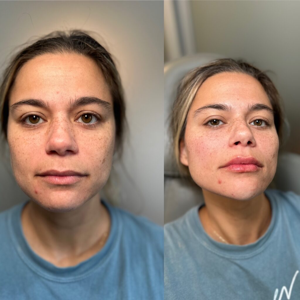 Before and after front view comparison of a woman’s face showing clear improvements in complexion and skin texture.