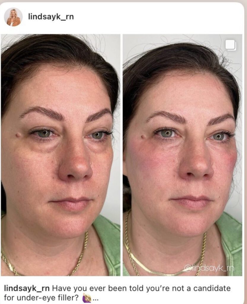 Before and after comparison of a woman's face showing improvements after an under-eye filler treatment.