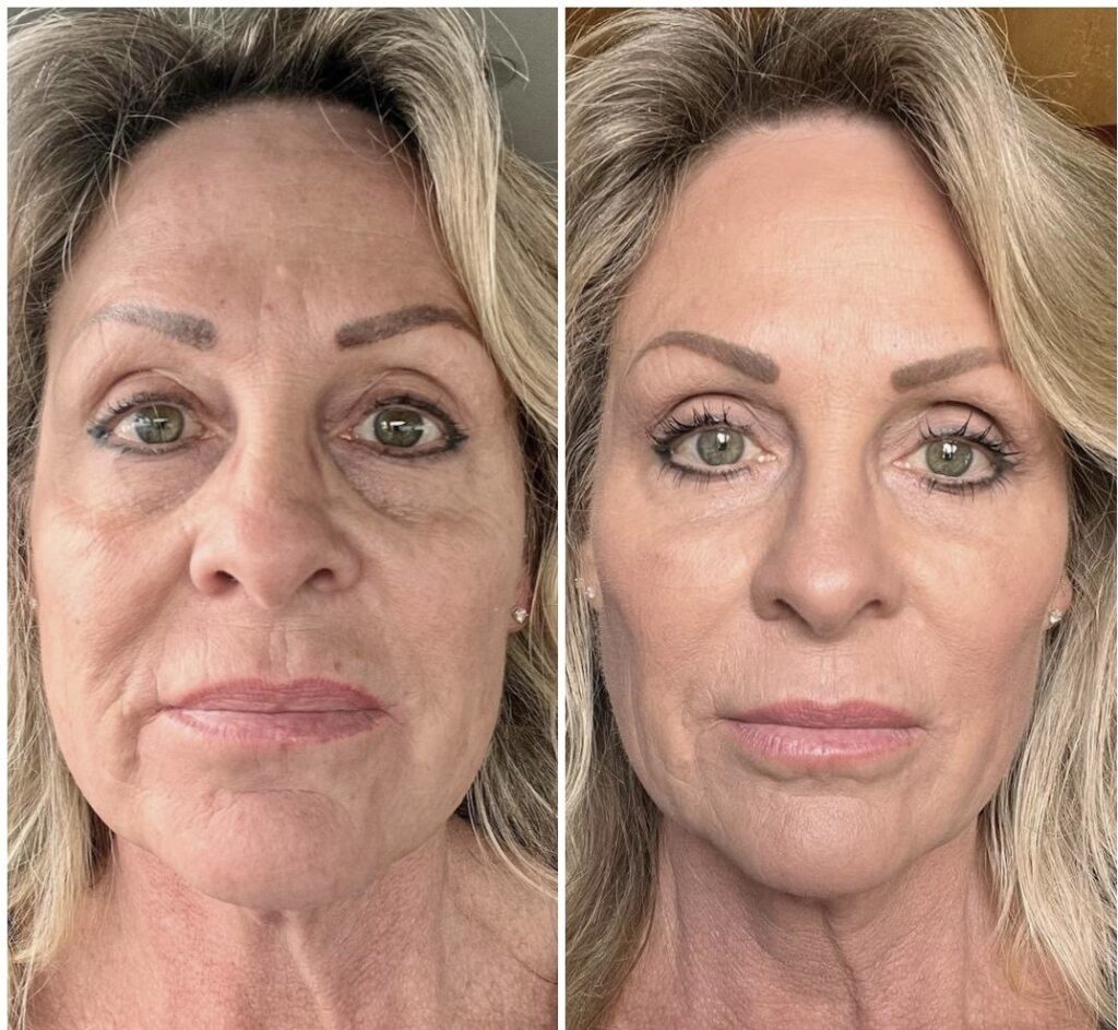 Before and after facial rejuvenation comparison showing a reduction in wrinkles and improved skin texture.