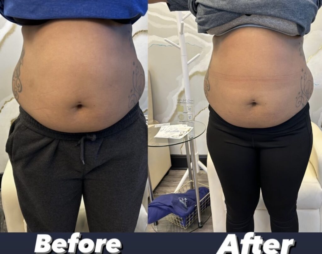 Before and after comparison of a woman's midsection showing the results of a body sculpting treatment.