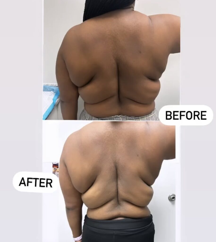 Before and after back view showing results from a body contouring treatment.