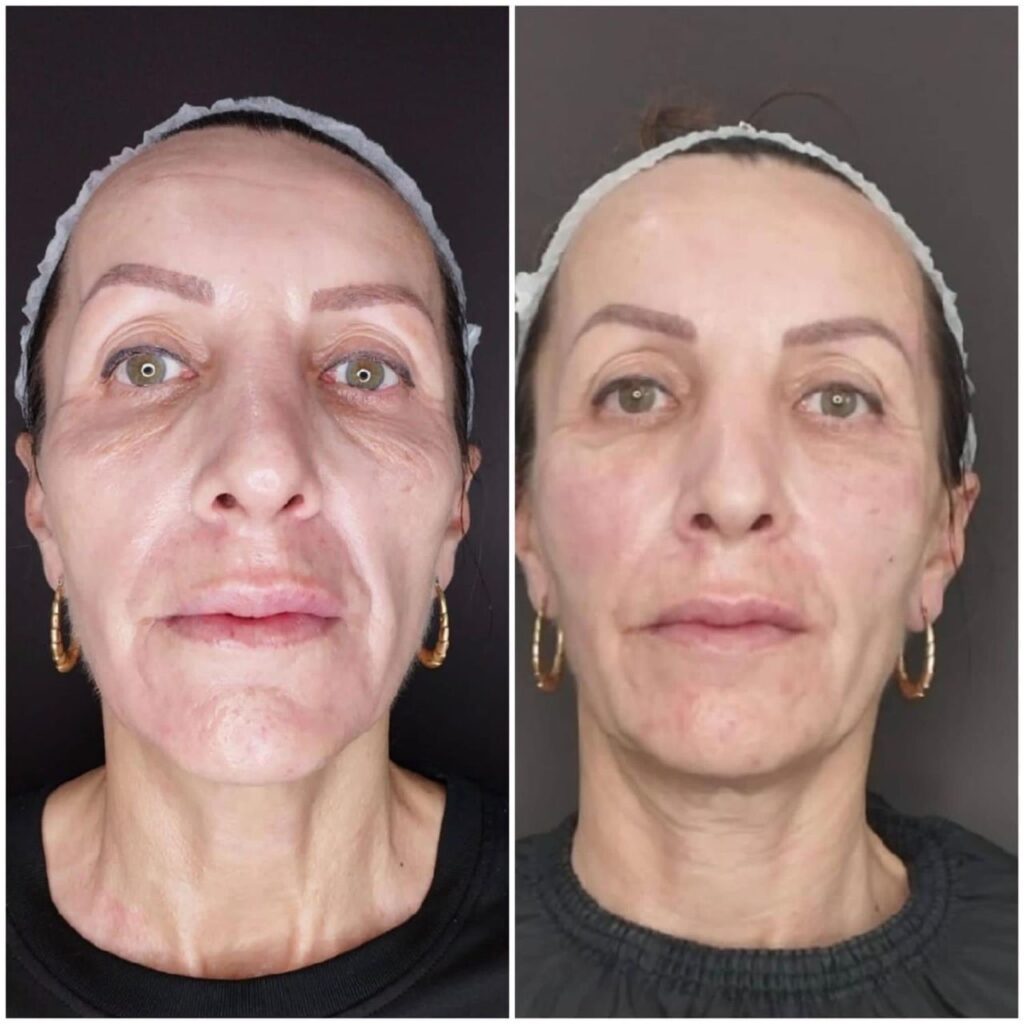 Before and after front-view comparison of a woman's face showing results from a cosmetic treatment.