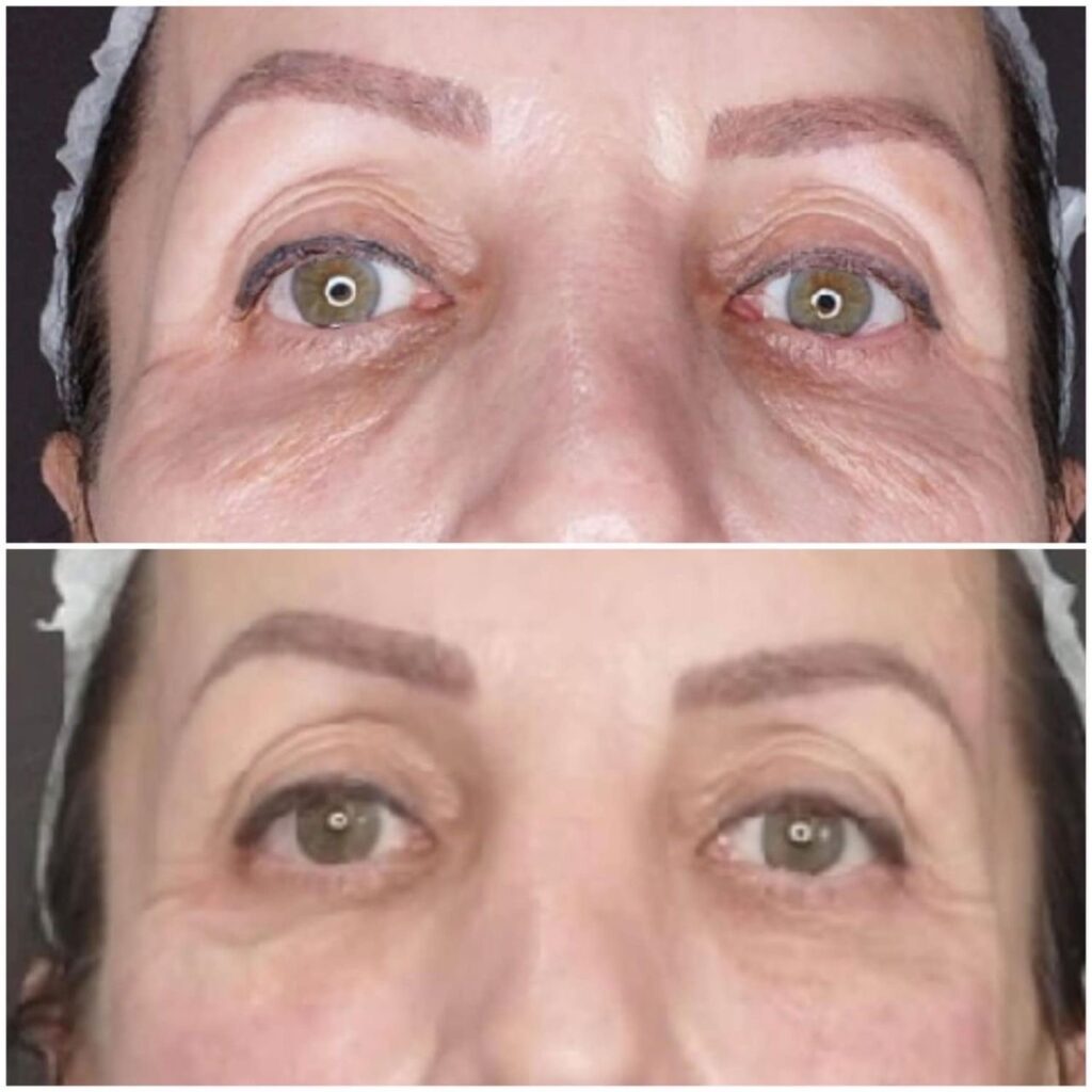 Before and after close-up of a woman's eyes showing the effects of a cosmetic treatment.